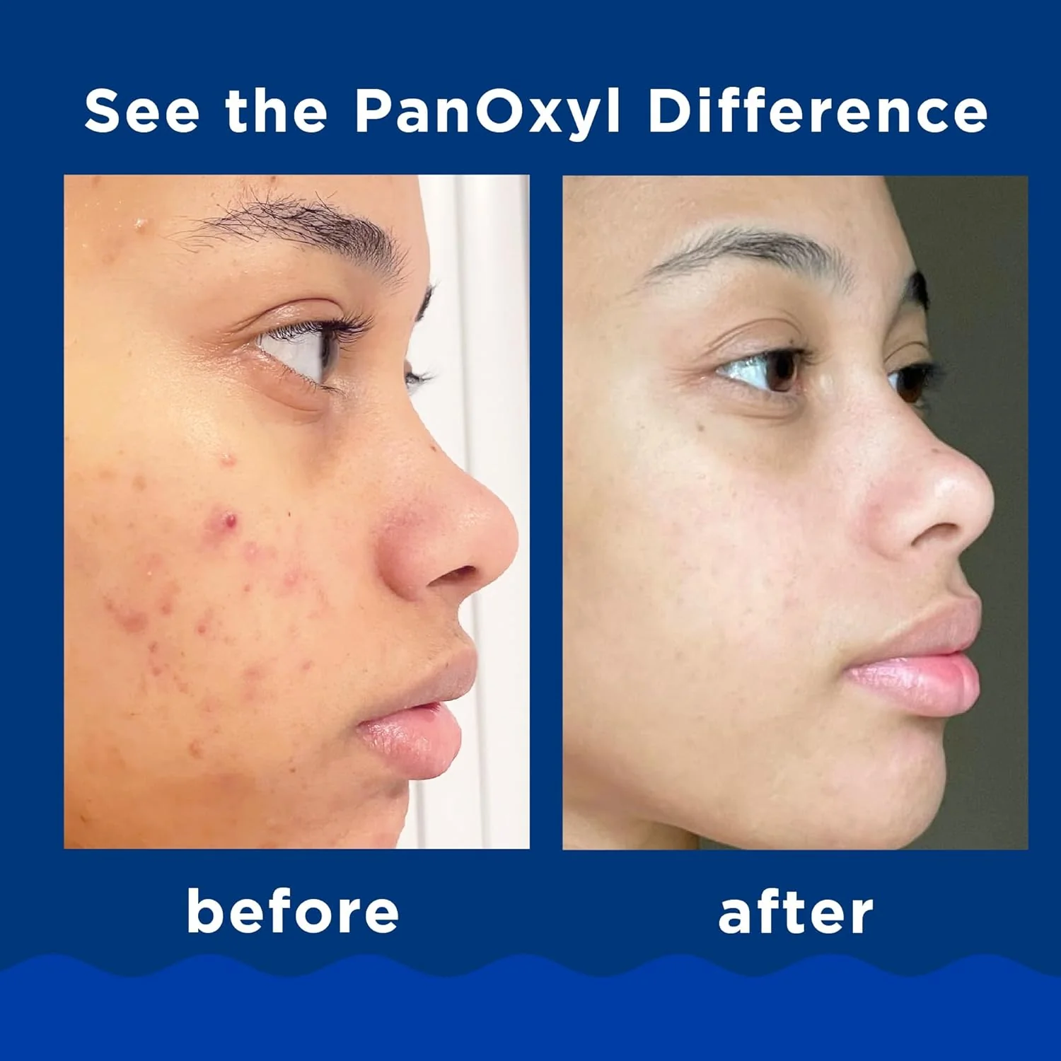 PanOxyl Acne Creamy Wash Benzoyl Peroxide 4% Daily Control - Image 4