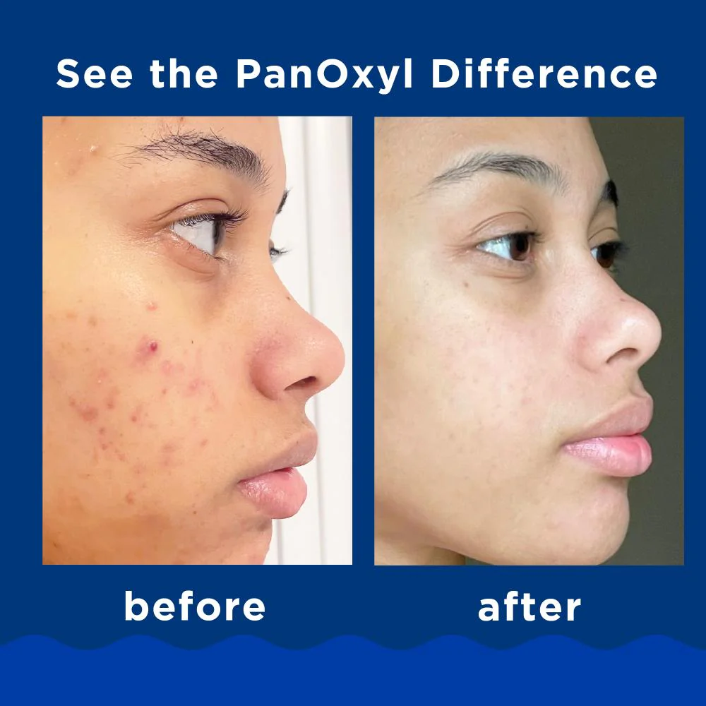 Panoxyl Acne Foaming Wash Benzoyl Peroxide 10% Maximum Strength 5.5 oz - Image 3